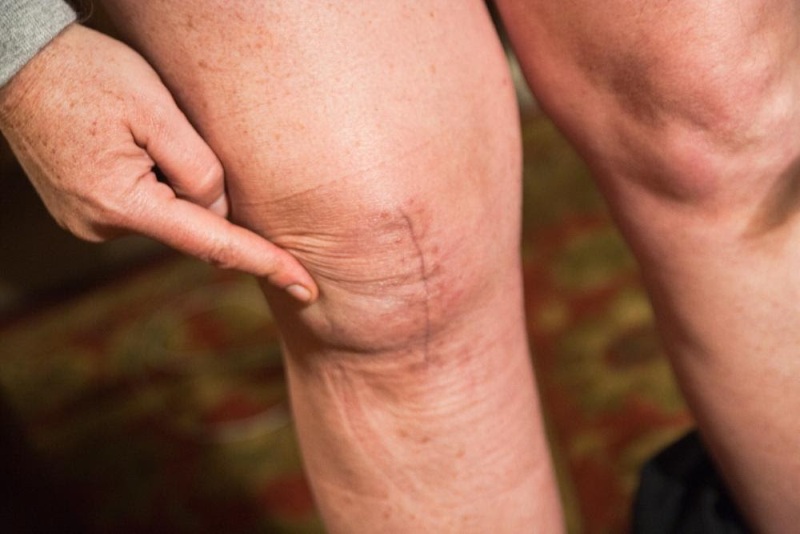 5-Tested-Tips-to-Take-Care-of-Your-New-Knee-Joint-1.jpg